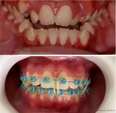 APARELHO METALICO 3 1