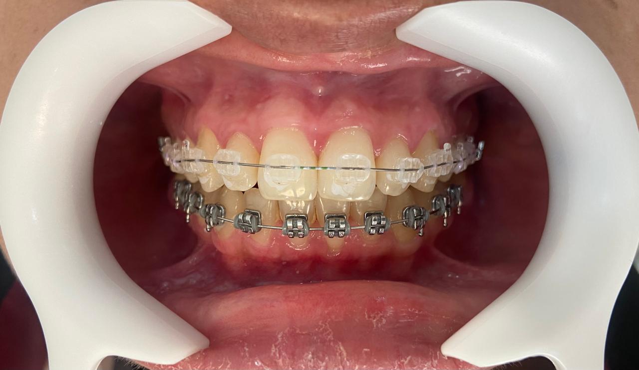 Sup. Safira e Inf. metalico.jfif (1)